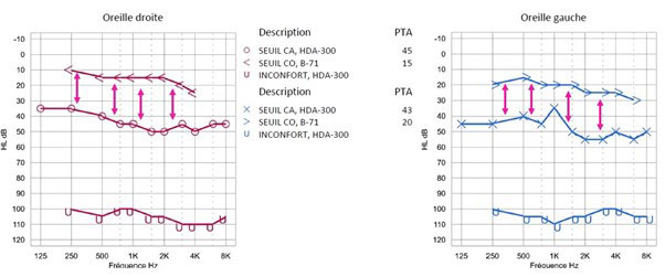 Audiogramme indiquant une surdité de transmission avec une courbe de conduction aérienne plus basse que la courbe de conduction osseuse.