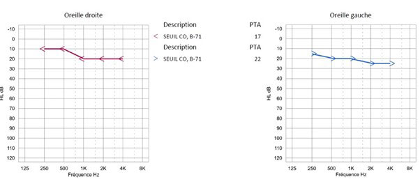 Audiogramme tonal par conduction osseuse